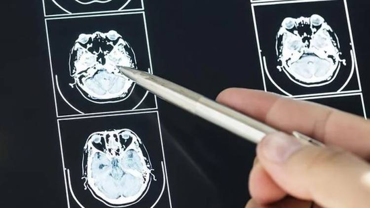 Cada día se detectan en Argentina 5 casos de tumores cerebrales: ¿cuáles son los signos de alerta?